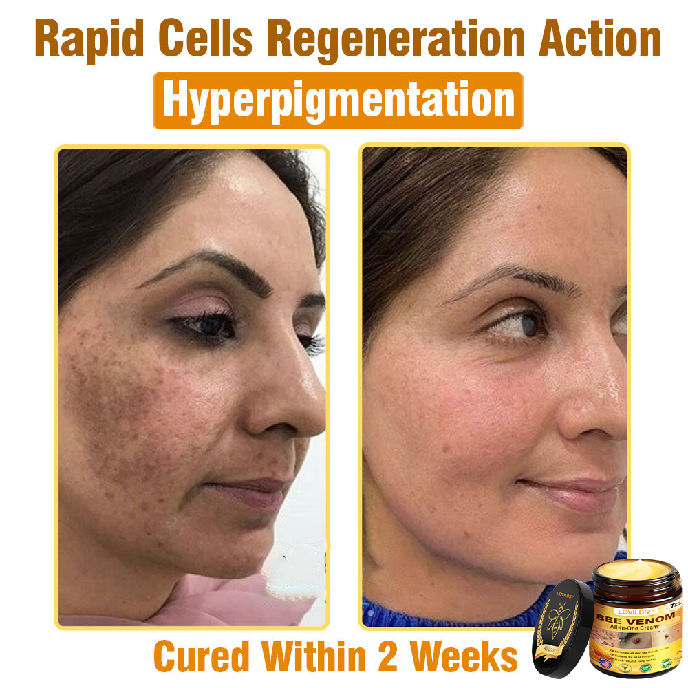 LOVILDS™ Bee Venom Cream – 🌸 Anti-Aging, Hydrating & Skin Repair